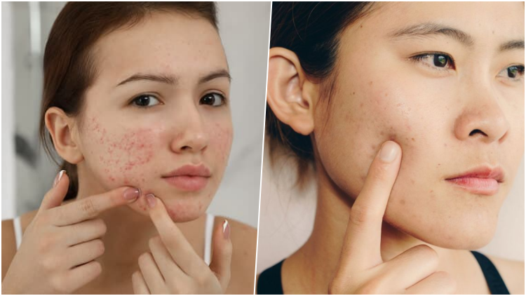 Wajah Berjerawat juga Berhak Lho Menggunakan Make Up Wajah Berjerawat juga Berhak Lho Menggunakan Make Up